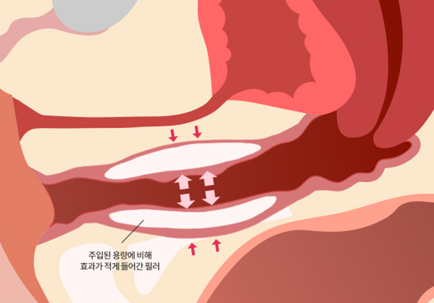 일반G필러