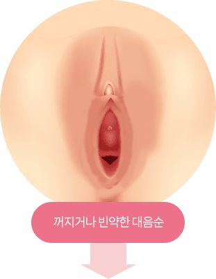 대음순 지방이식, 필러