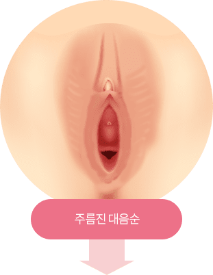 대음순 거상술, 필러