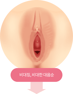 대음순 축소술